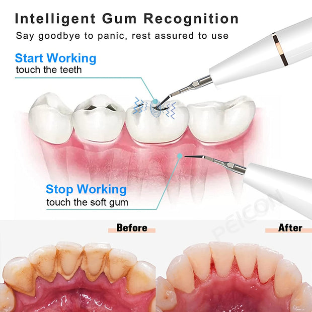 Ultrasonic Dental Scaler For Teeth